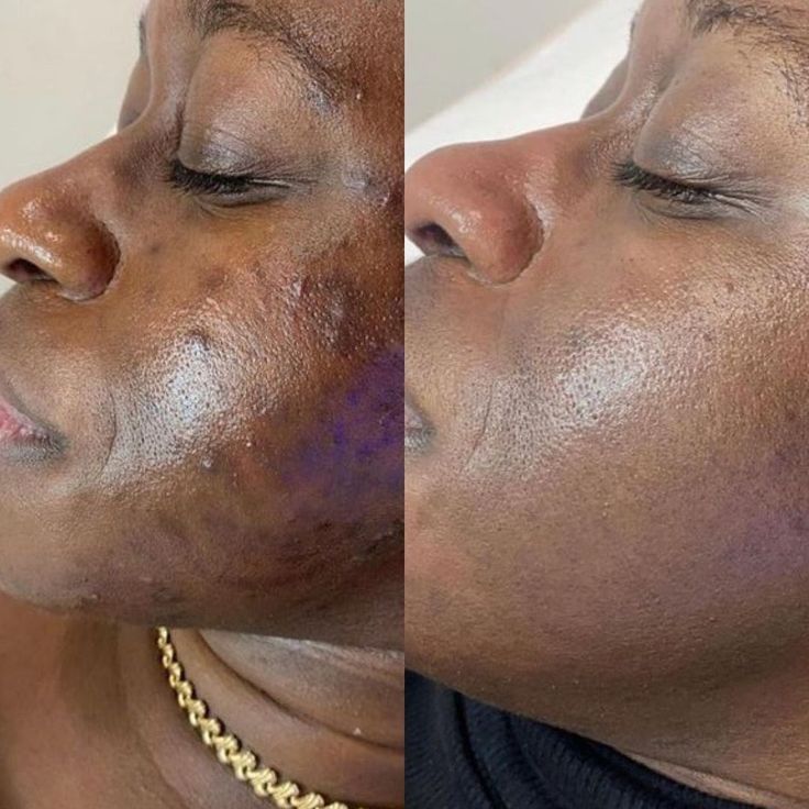 Bujari Acne Care